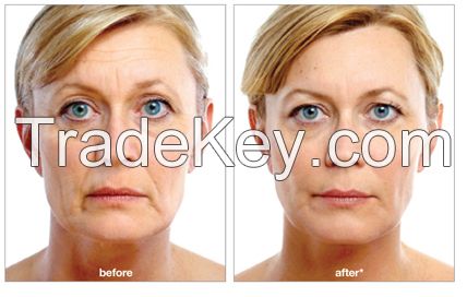 Dermal Fillers, Anti Aging Treatment