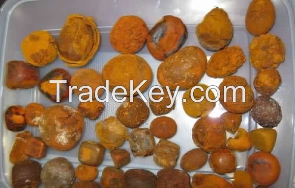 Gallstones