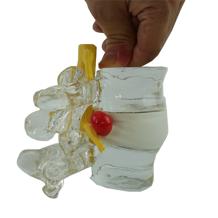 Human Crystal Vertebral Simulator Lumbar Disc Herniation Model