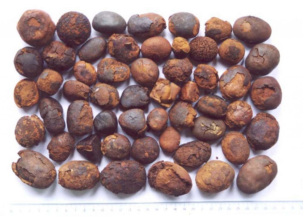 gallstone