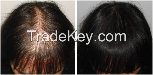 Hair Transplant - Get 2000 Grafts for Only $4100