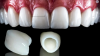 Titanium Ceramic Crown False Teeth Ceramic Teeth