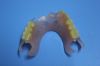 Sell detal valplast denture