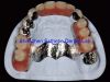 Sell   telescope  dental crown