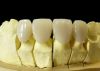 Sell Dental Cr-Co Porcelain Crown/ Porcelain Fused to Cr-Co Crown (PFM