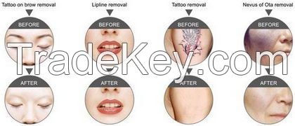 Hot sale Q switch ND Yag laser tattoo removal machine with CE ISO certificate