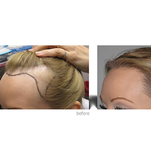 Hair Transplant for Female Pattern Baldness