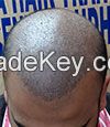 Hair Transplant for Male Pattern Baldness in India 