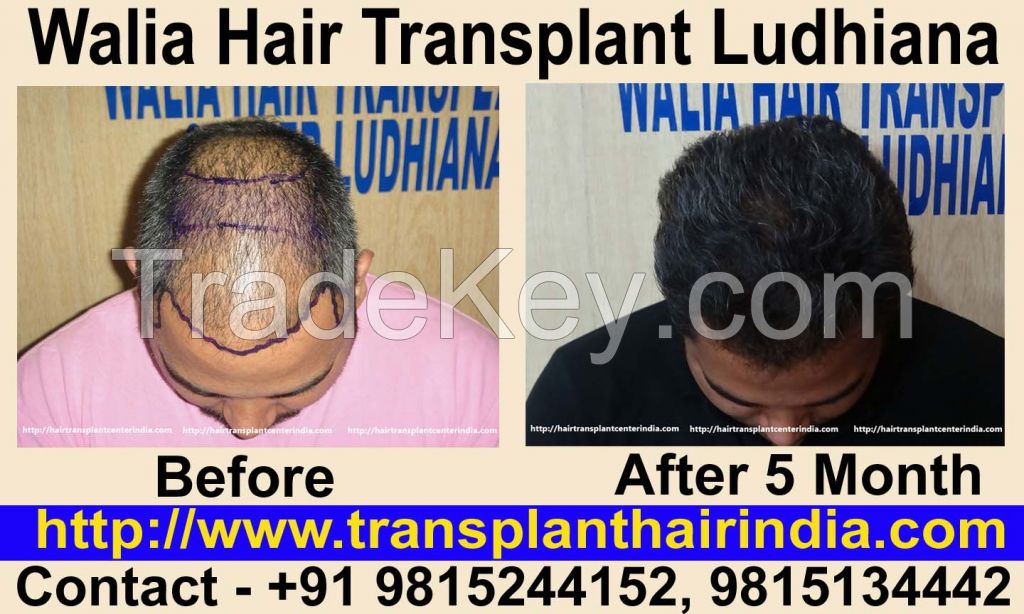 Walia Hair Transplant India Affordable Cost 