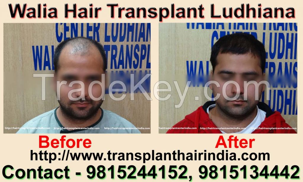 Walia Hair Transplant India Affordable Cost 
