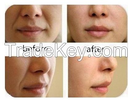 1ml facial wrinkle hyaluronic acid dermal injection filler 