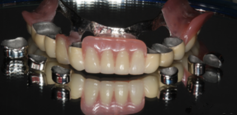 Dental implant zirconia crown and bridge dental supplies