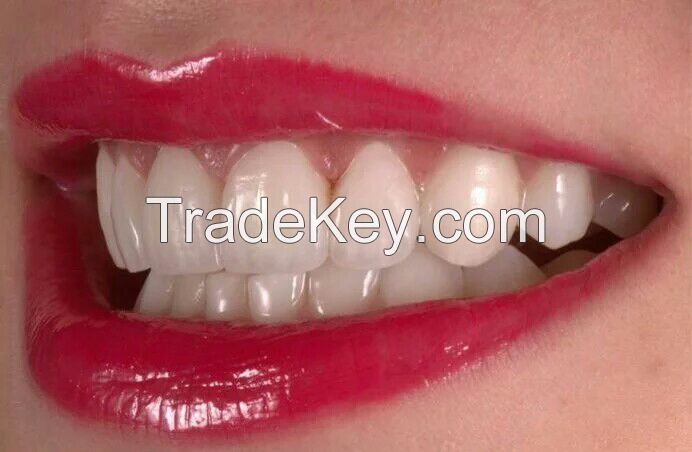 Dental porcelain esthetic emax veneer