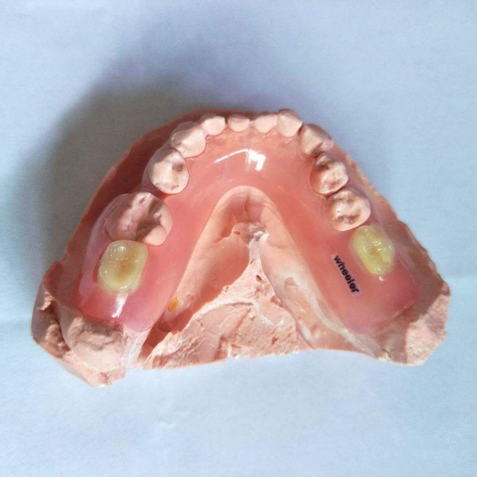 removable denture, dental restorations, dental supplies