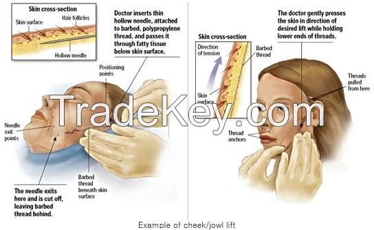 Sterile PDO Lifting Threads Polydioxanone Suture with Needle