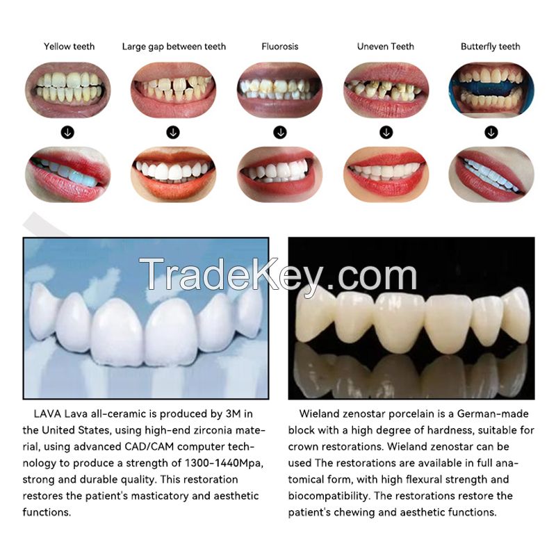 All Ceramic Dentures - Zirconia Base