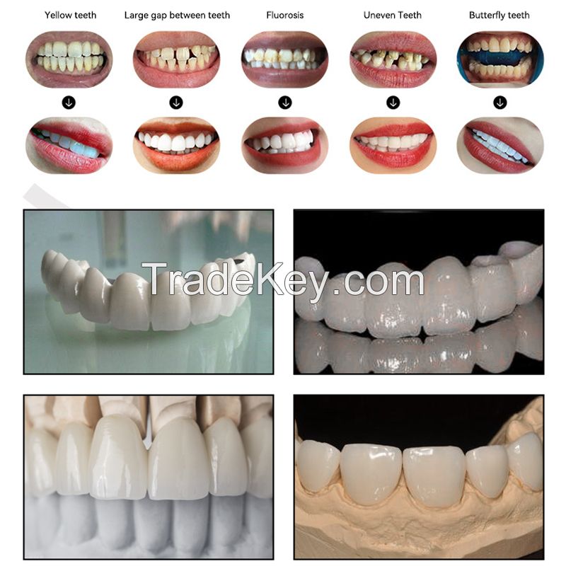 Metal Porcelain Denture - Pure Titanium Polymer Porcelain