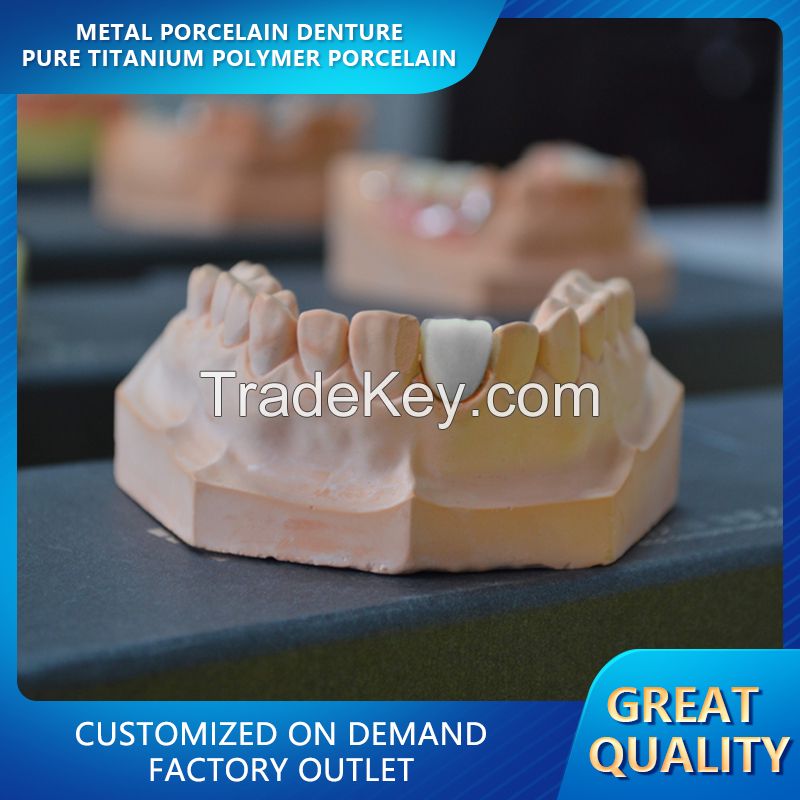 Metal Porcelain Denture - Pure Titanium Polymer Porcelain