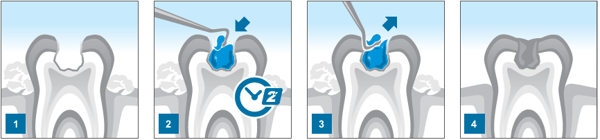 Carie Fix Dental Caries Removing Gel