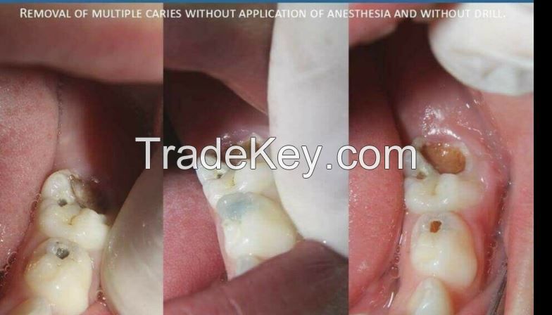 Carie Fix Dental Caries Removing Gel