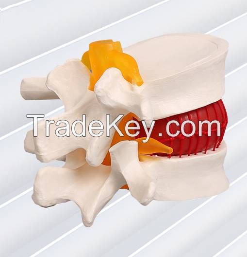 Lumbar disc herniation demonstration model