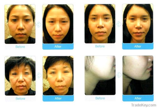 Medical facial lifting thread for plastic surgery