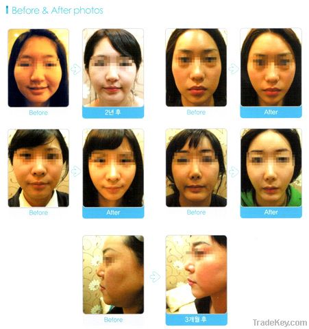 Medical facial lifting thread for plastic surgery