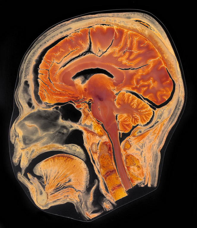 Head Slice (Median Sagittal Plane)