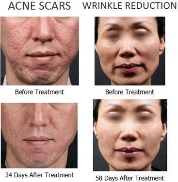 AES-FRF83(Wrinkle removal, Facial wrinkle removal, Skin tightening, Skin Resurfacing, Skin rejuvenation Fine and Coarse wrinkles, Stretch marks removal, Face lifting Acne Scars removal, acne scars, large pores and stretch marks.)