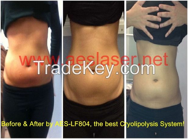 Cryolipolysis system for lose fat