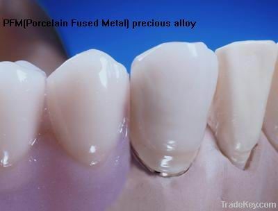 Porcelain Fused Metal (PFM)