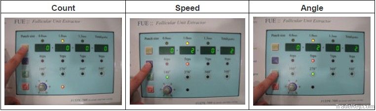 Follicular Unit Extraction (FUE)