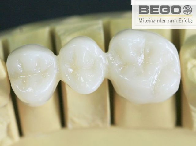 PFM Metal Porcelain Dental Crown