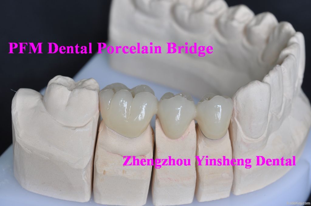 Ni-Cr Alloy Be  free PFM dental crown and bridge