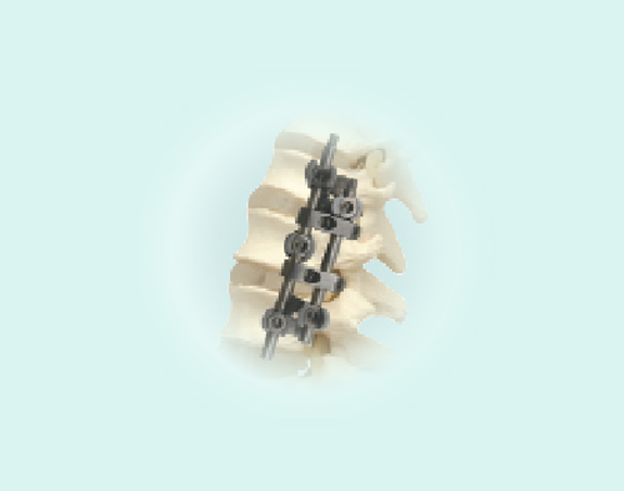 spinal implant/spinal fixation system