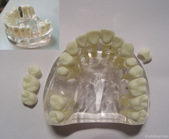 Dental Implant/Patient Education Models