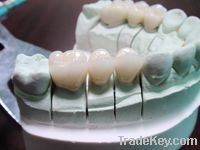 Porcelain Fused to Metal Crown & Bridge