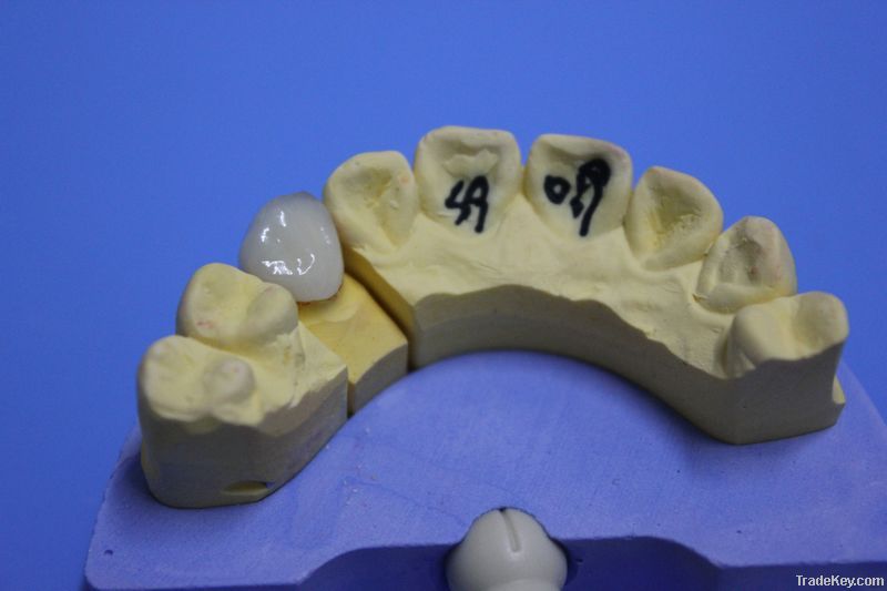 Dental Porcelain-Fused-To-Metal Crown