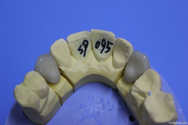 Dental Porcelain-Fused-To-Metal Crown