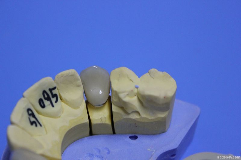 Dental Porcelain-Fused-To-Metal Crown