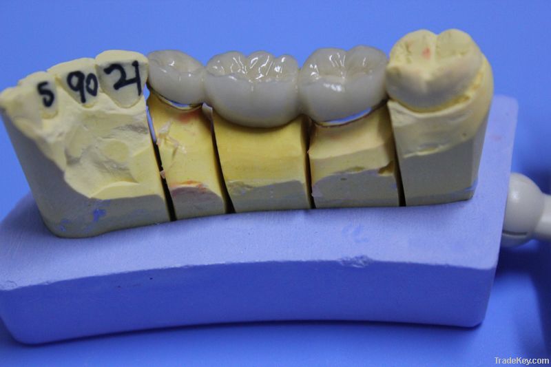 Dental Porcelain-Fused-To-Metal Crown