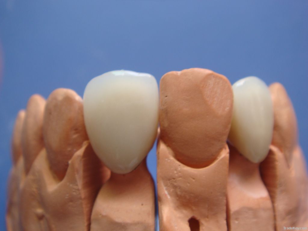 Dental porcelai fused to metal crown