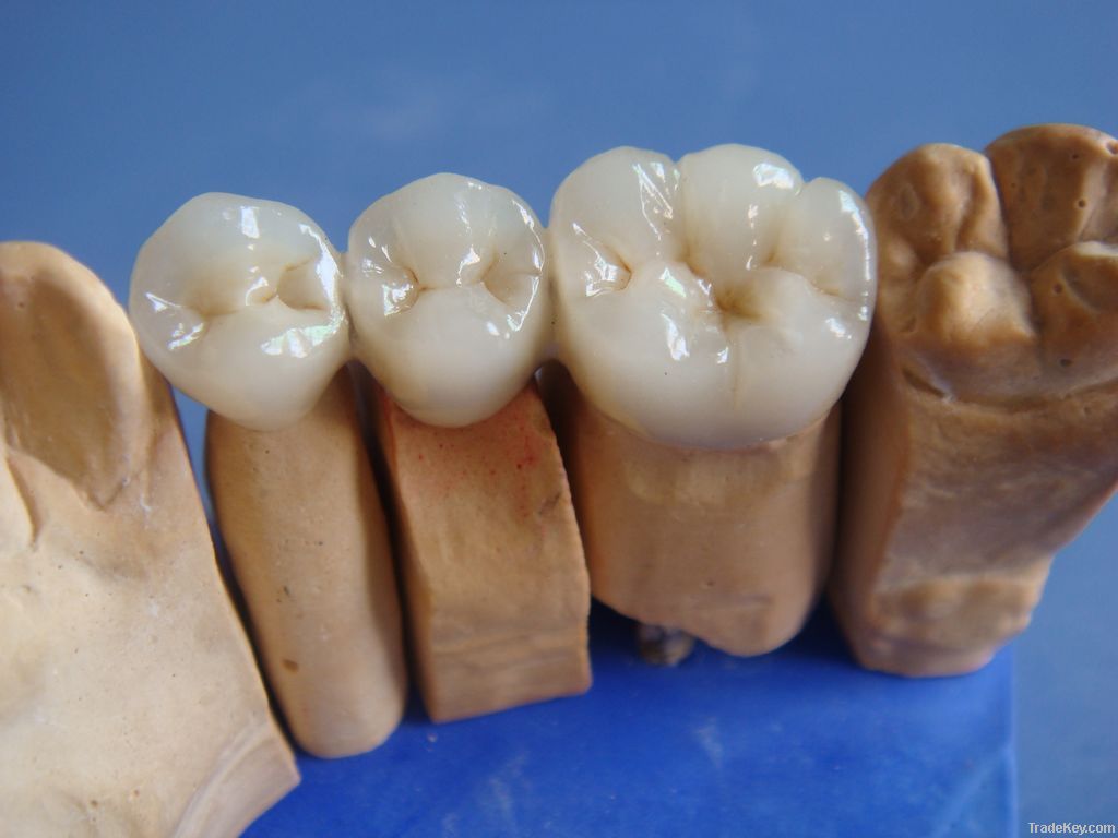 Dental porcelai fused to metal crown-