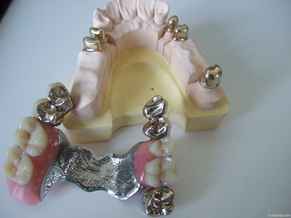 Dental telescope crown