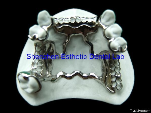 Dental metal partial framework