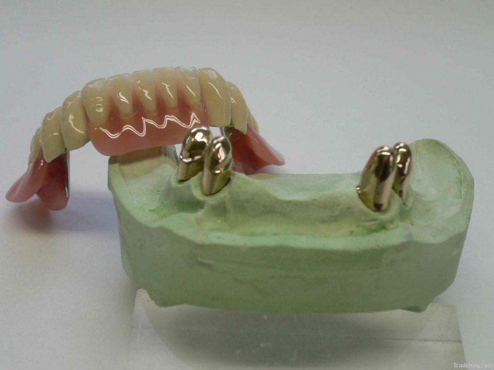 Dental telescope crown