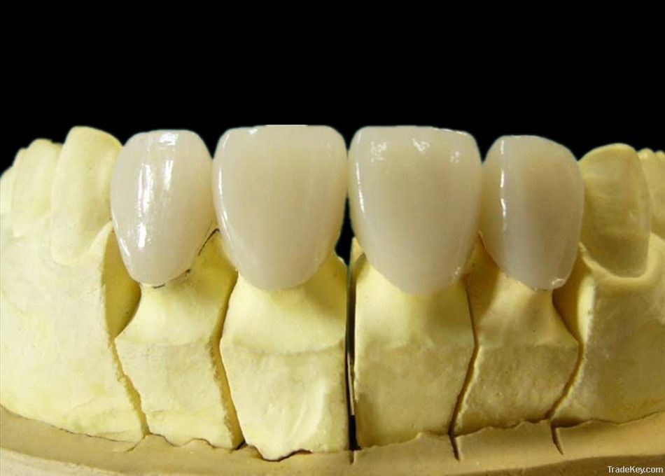 Dental Cr-Co Porcelain Crown/ Porcelain Fused to Cr-Co Crown (PFM)