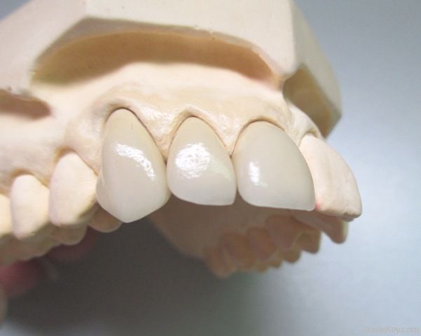 Dental Porcelain fused to Pure Titanium crown (PFM)