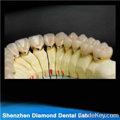 Dental Precious pfm crown and bridge