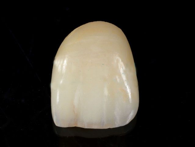 Denture (Metal-Free,E.max Crown)